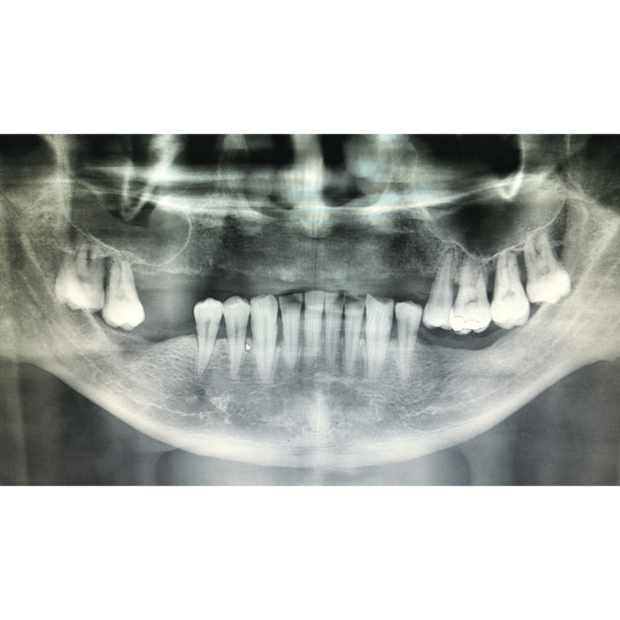 FULL MOUTH DENTAL IMPLANT BY DIGITAL SYSTEM - BFC Dental