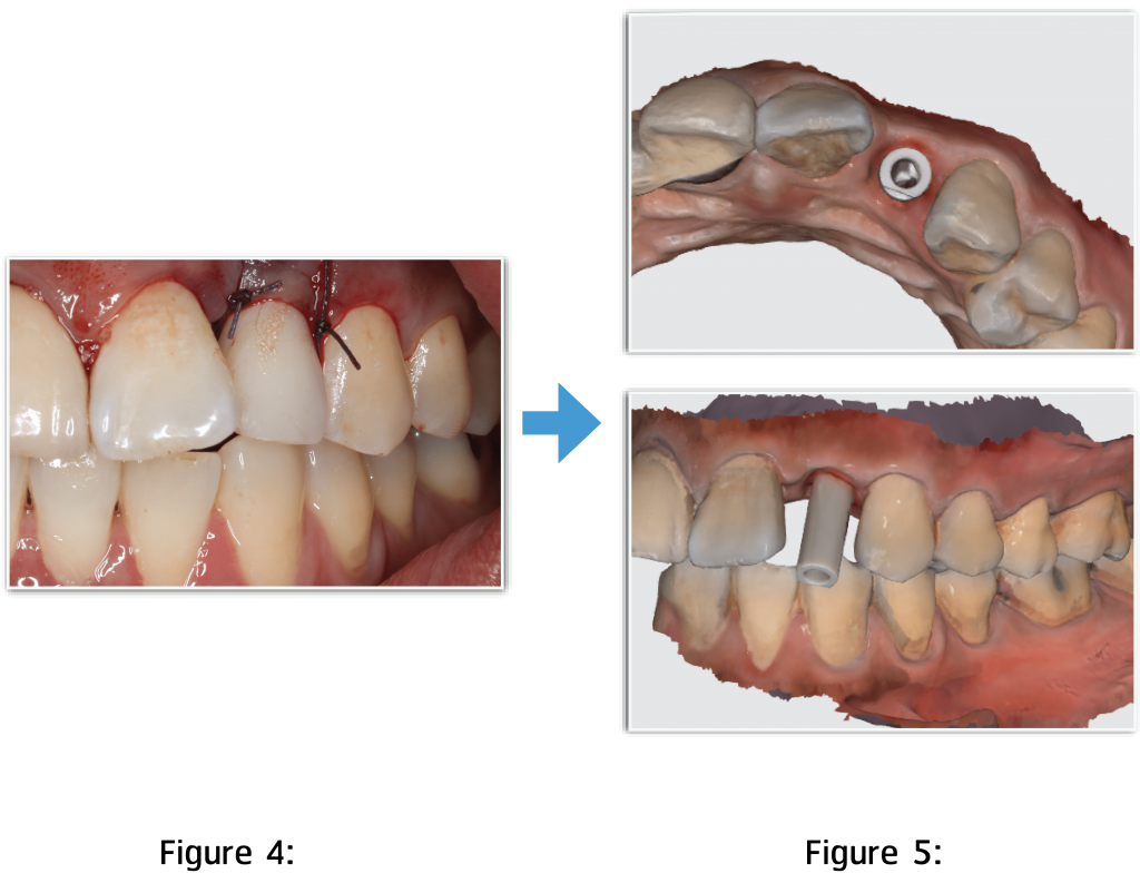 implant-loading-with-an-immediate-crown-within-1-hour