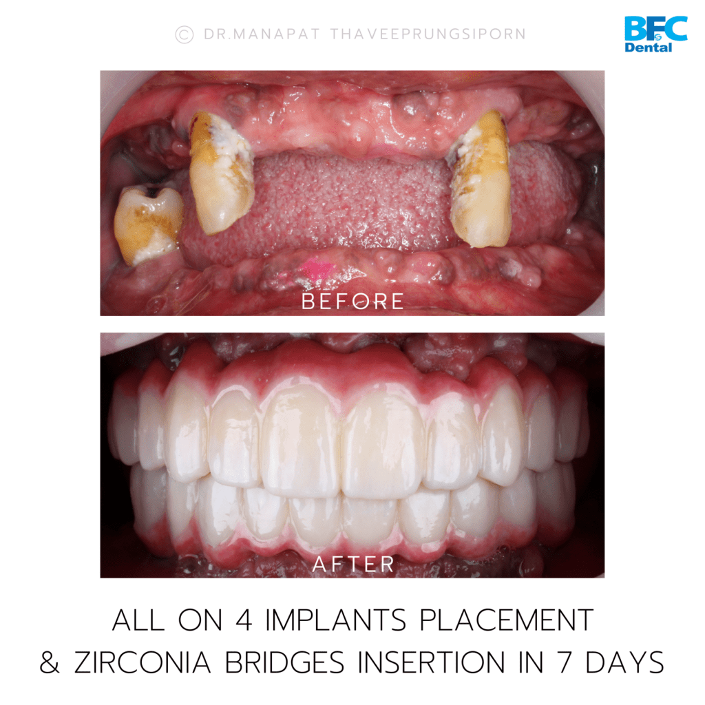 Full Mouth Dental Implants (All on 4) with Digital Implants Workflow ...