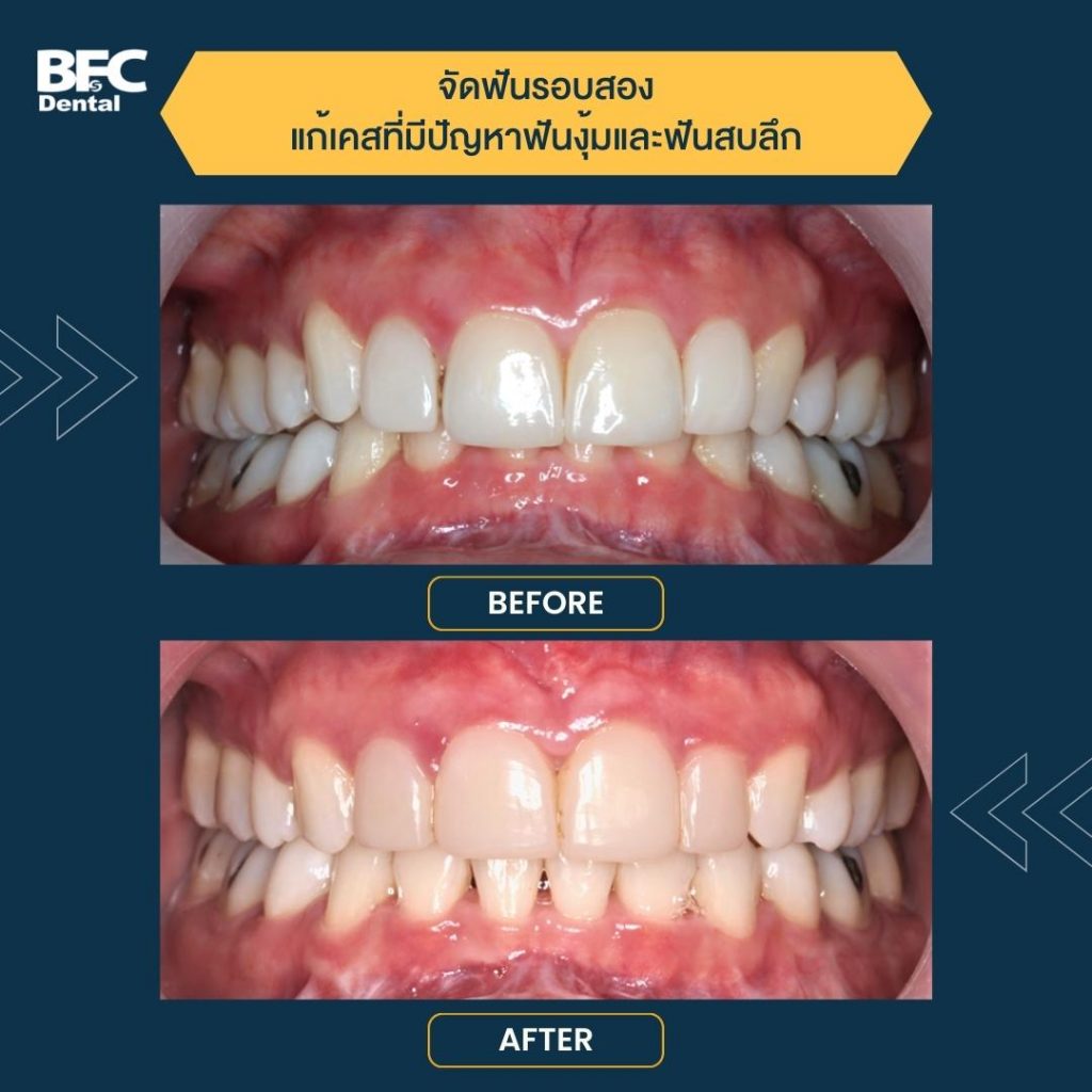 แก้ ฟันงุ้ม ทวงคืนฟันสวยรอบสอง ด้วยจัดฟันเร็ว Wepass - Bfc Dental
