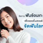 จัดการฟันซ้อนเกในฟันหน้า เพื่อรอยยิ้มสวยด้วย จัดฟันโลหะ