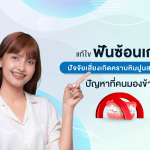 แก้ไขฟันซ้อนเก ปัจจัยเสี่ยงเกิดคราบหินปูนสะสม ปัญหาที่คนมองข้าม