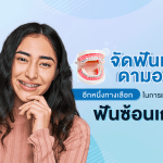 จัดฟันเร็ว ดามอน อีกหนึ่งทางเลือกในการแก้ไขฟันซ้อนเก