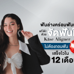 ฟันล่างคร่อมฟันบนแก้ได้! ด้วย จัดฟันใส Käse Aligner  ไม่ต้องถอนฟัน เสร็จไวใน 12 เดือน