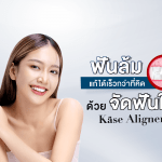 ฟันล้มแก้ได้เร็วกว่าที่คิด ด้วย จัดฟันใส Käse Aligner