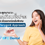 กระดูกบางก็ทำ รากเทียมทั้งปาก ได้! ด้วยเทคนิคฝังพิเศษ Pterygoid Approach ที่ BFC Dental