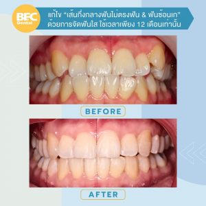 จัดฟันใส