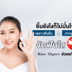 ยิ้มยังไงก็ไม่มั่นใจ เพราะฟันยื่น ปากอูม จัดฟันใส Käse Aligner ช่วยแก้ได้!