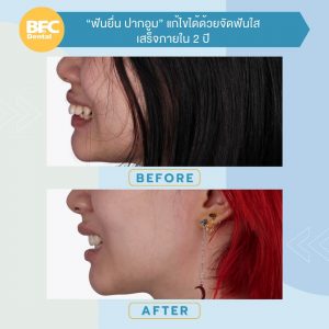 จัดฟันใส