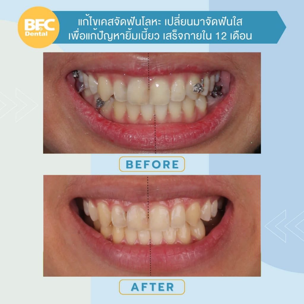 จัดฟันใส