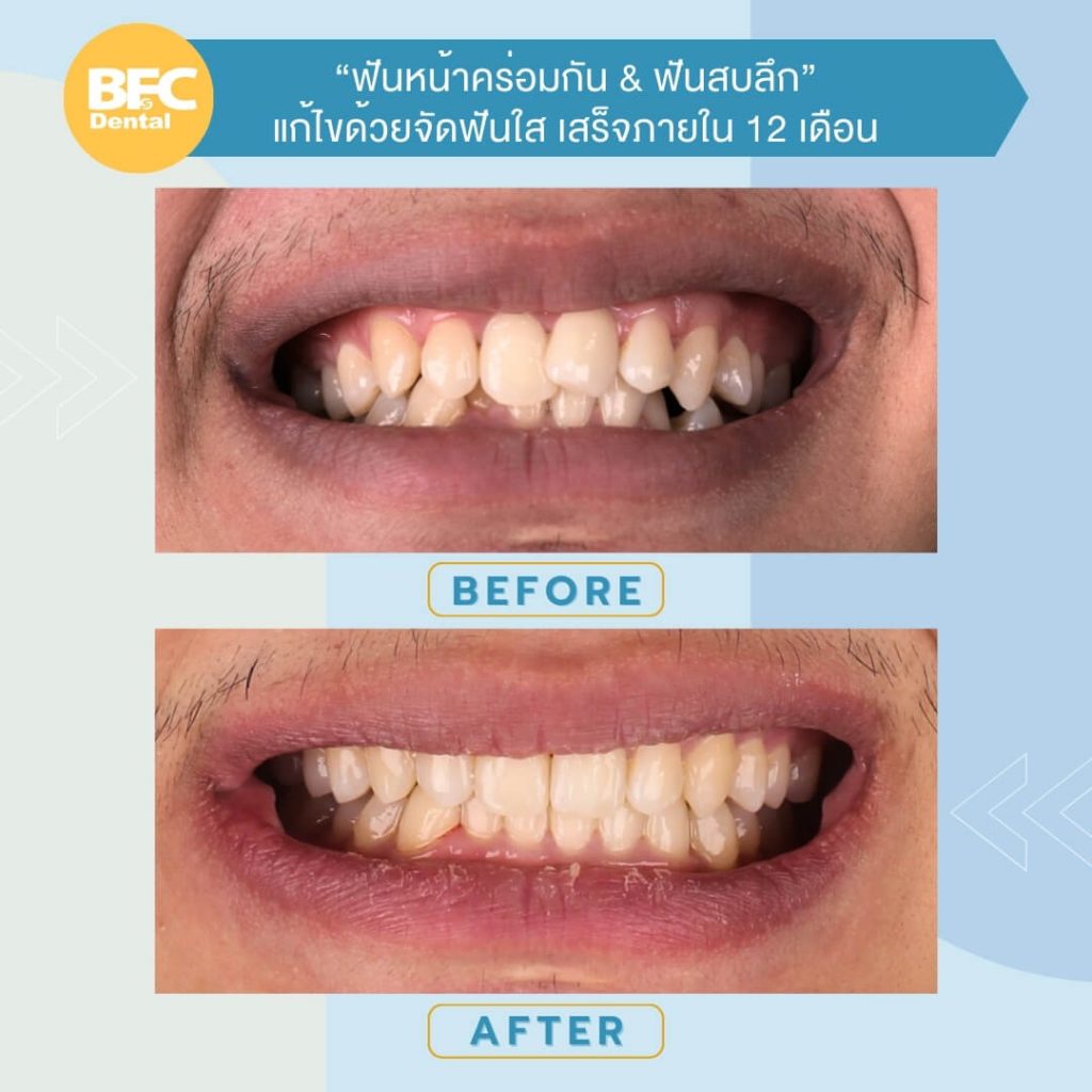 จัดฟันใส