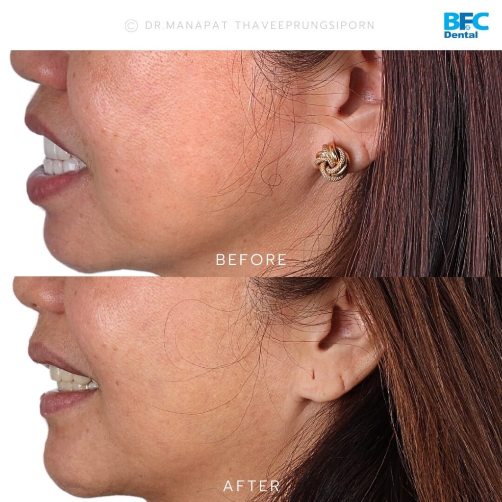 ทำรากเทียมทั้งปาก