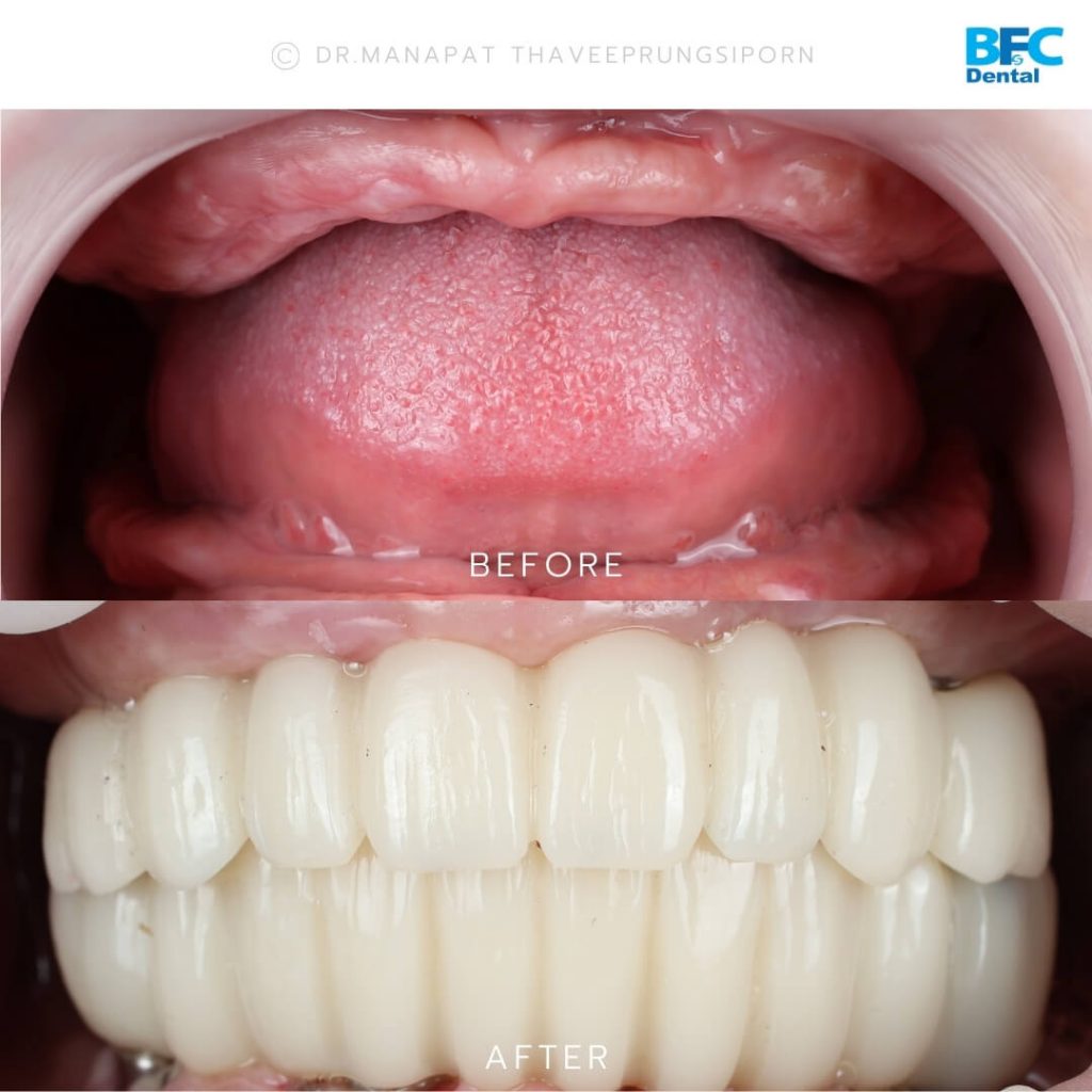 ทำรากเทียมทั้งปาก