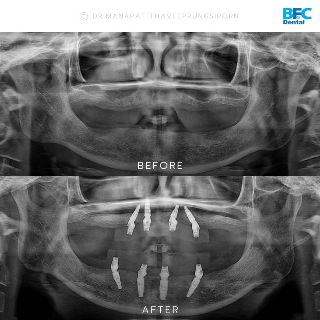 ทำรากเทียมทั้งปาก