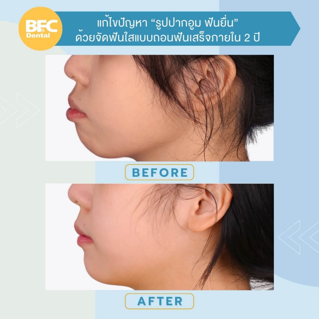 จัดฟันใส