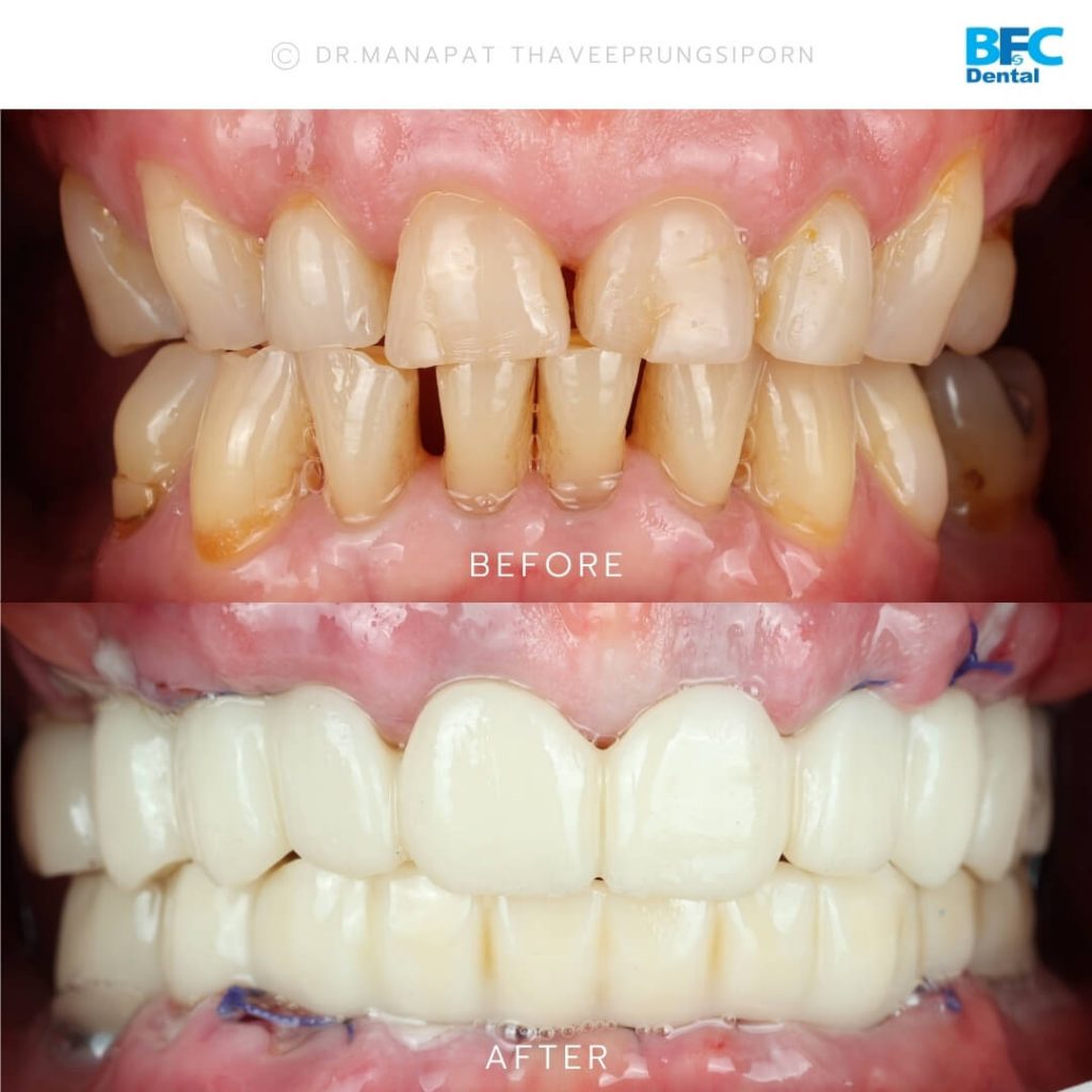 รากเทียมทั้งปาก All-on-4