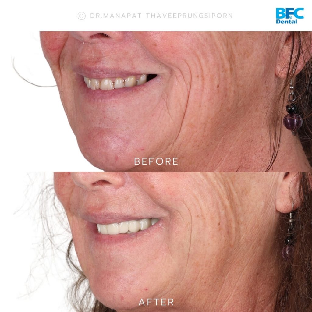 รากเทียมทั้งปาก All-on-4