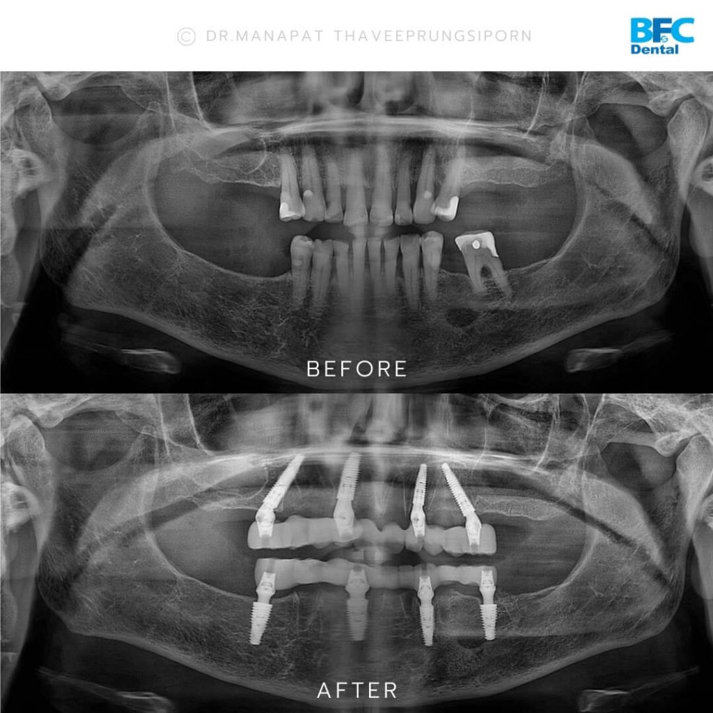 รากเทียมทั้งปาก All-on-4