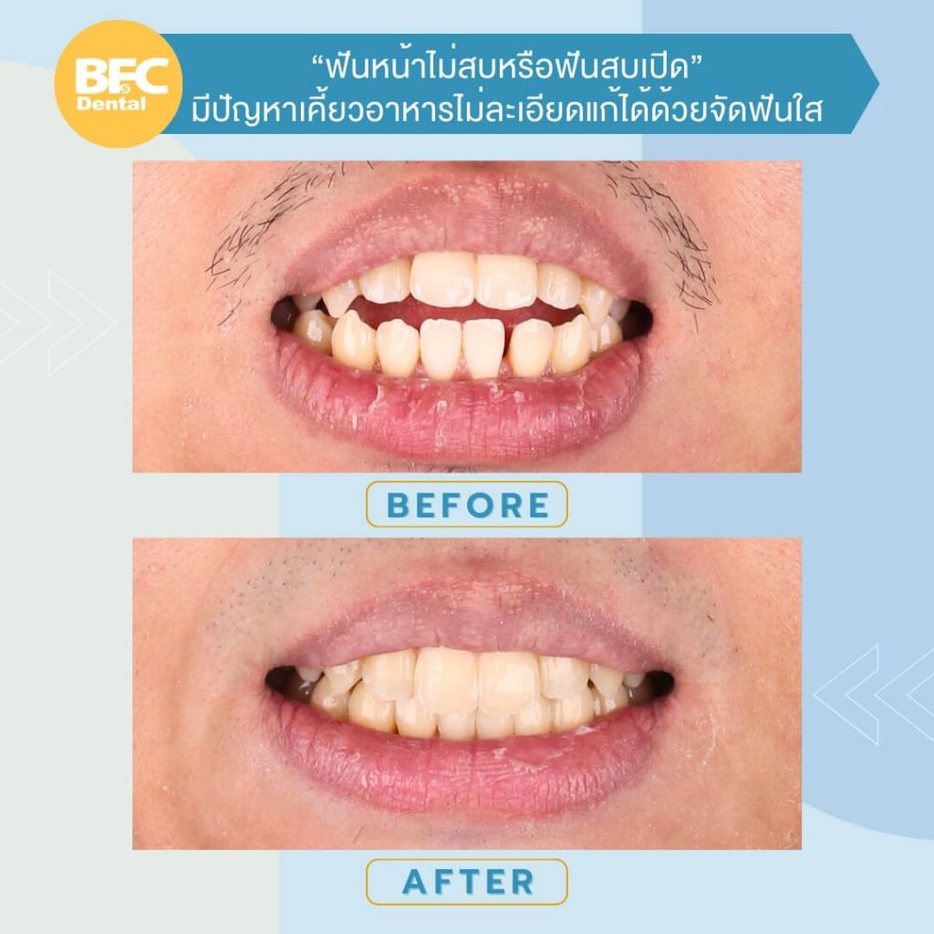 จัดฟันใส