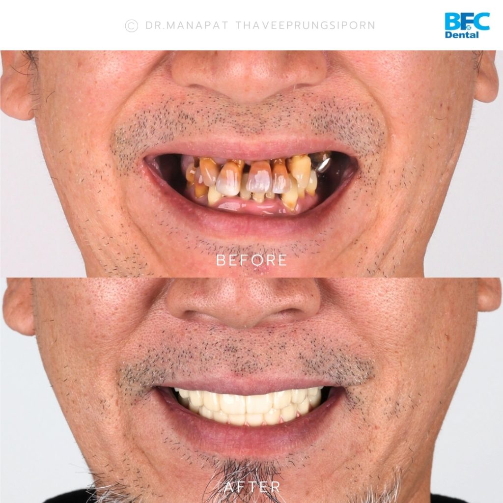 รากเทียมทั้งปากพร้อมปลูกกระดูก