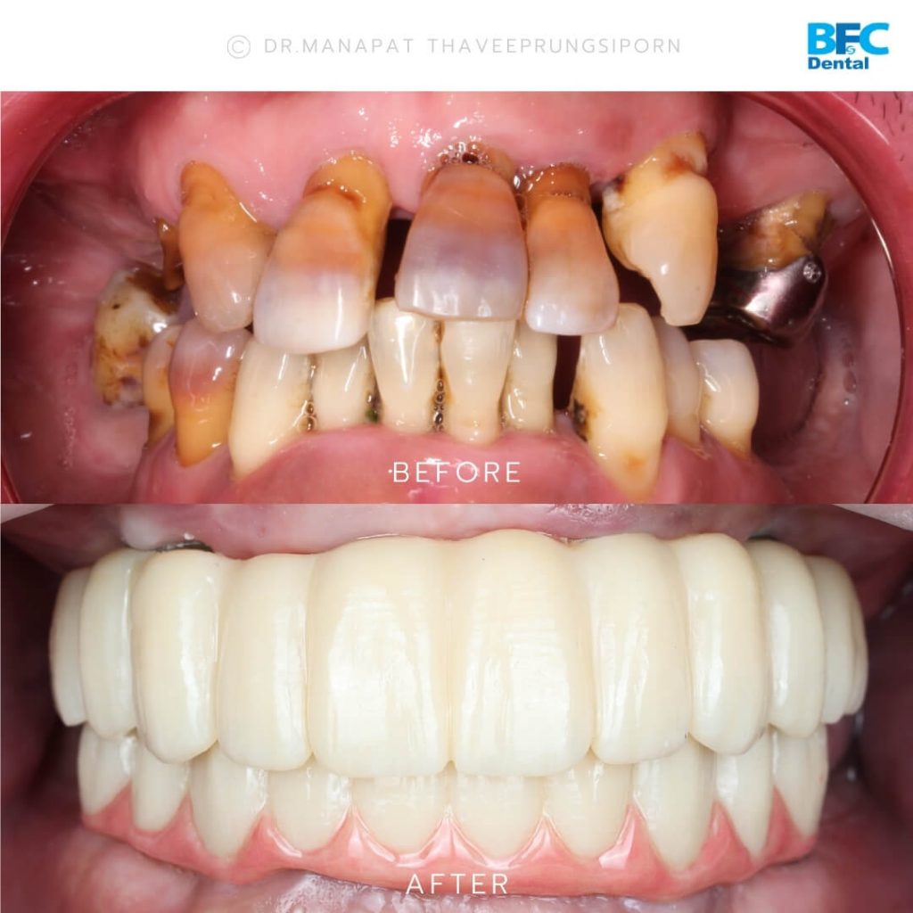 รากเทียมทั้งปากพร้อมปลูกกระดูก