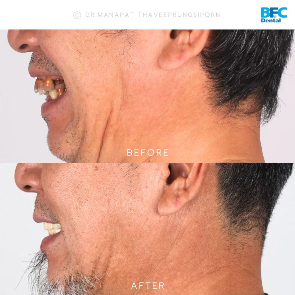 รากเทียมทั้งปากพร้อมปลูกกระดูก