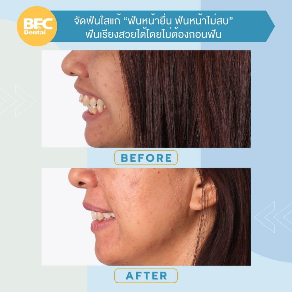 จัดฟันใส