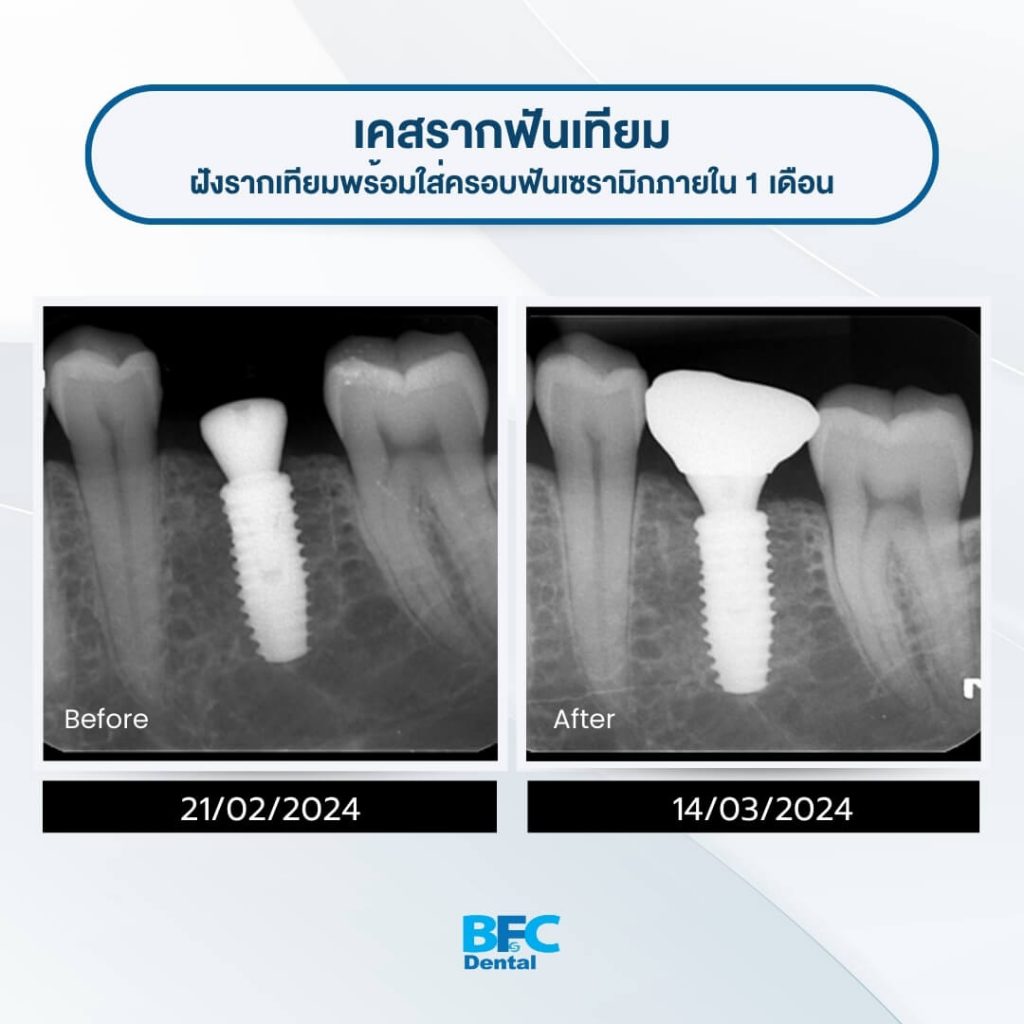 ฝังรากเทียมแบบซี่เดียว