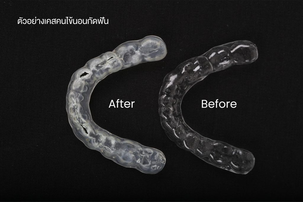 นอนกัดฟัน