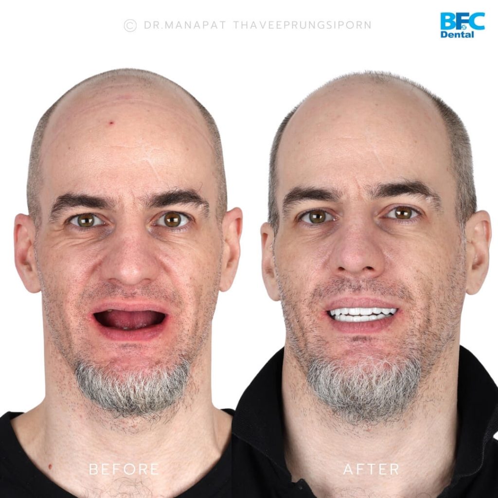 รากเทียมทั้งปาก