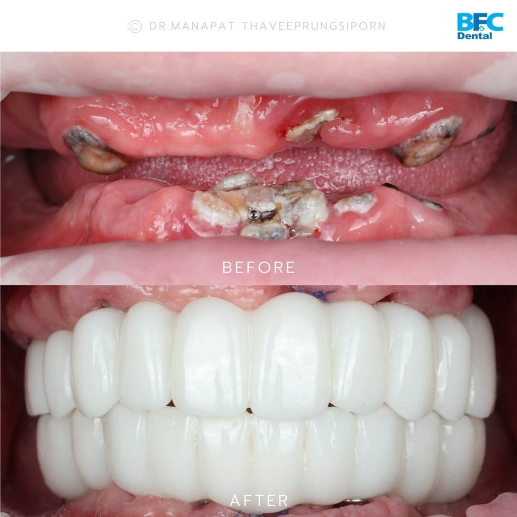 รากเทียมทั้งปาก