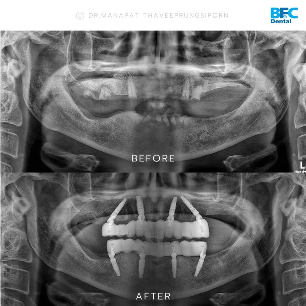 รากเทียมทั้งปาก
