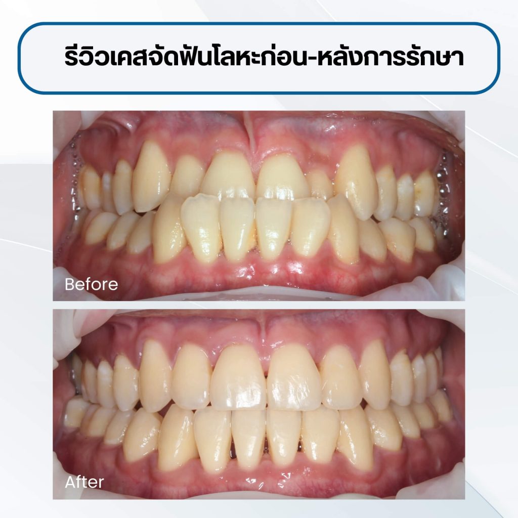 จัดฟันระบบ Self-ligating