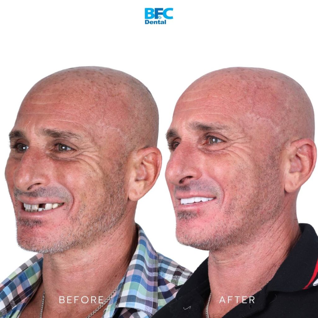 รากเทียมทั้งปาก