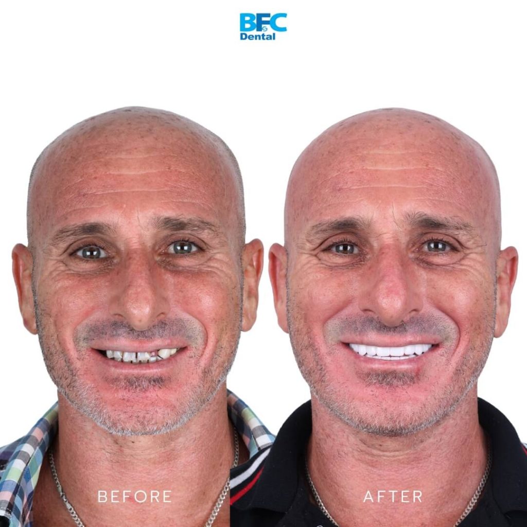 รากเทียมทั้งปาก