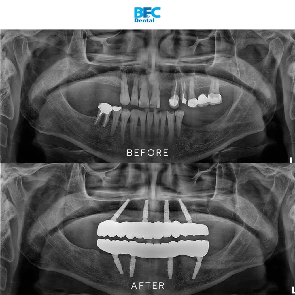 รากเทียมทั้งปาก