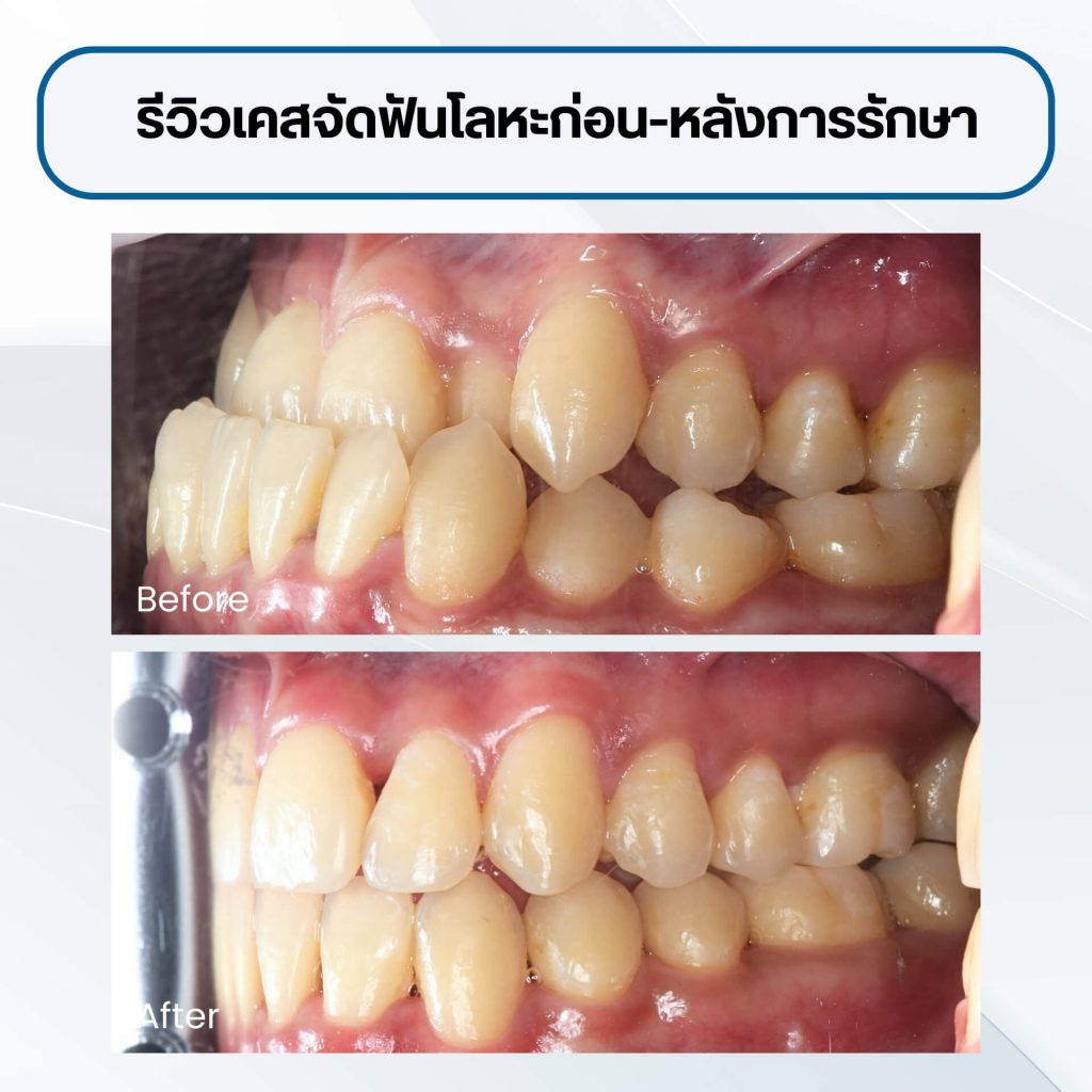จัดฟันระบบ Self-ligating