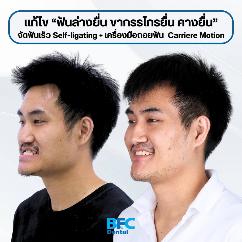 จัดฟันระบบ Self-ligating