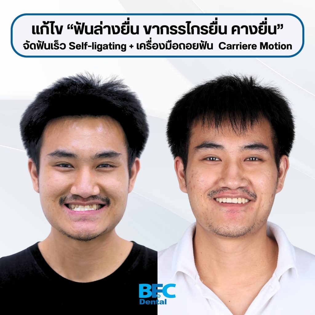 จัดฟันระบบ Self-ligating