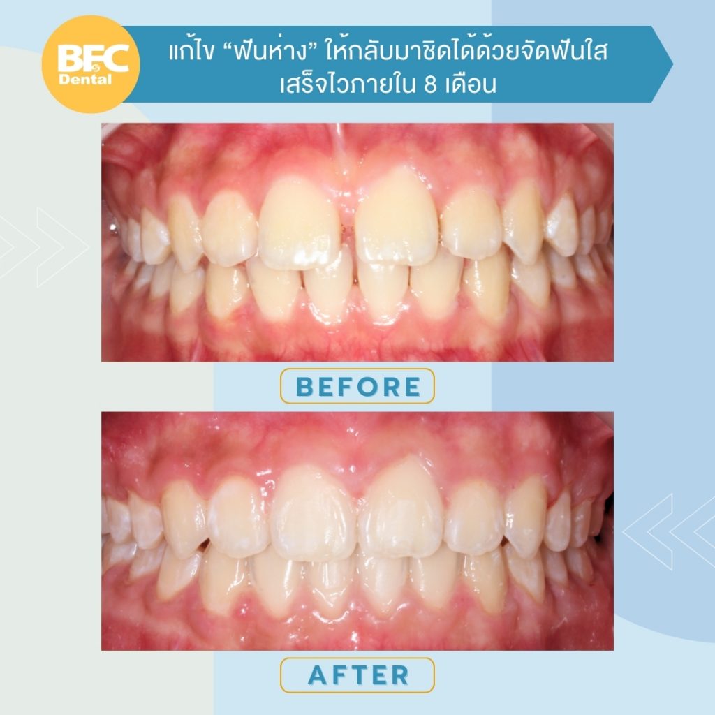จัดฟันใส Käse Aligner จัดการฟันห่าง