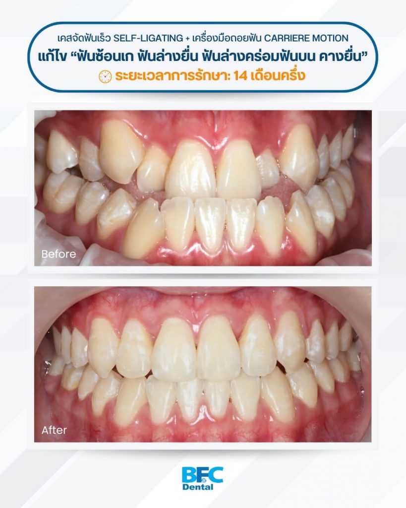 จัดฟันเร็ว Self-Ligating