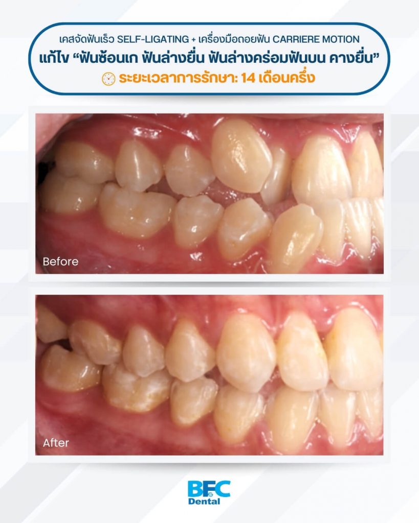 จัดฟันเร็ว Self-Ligating