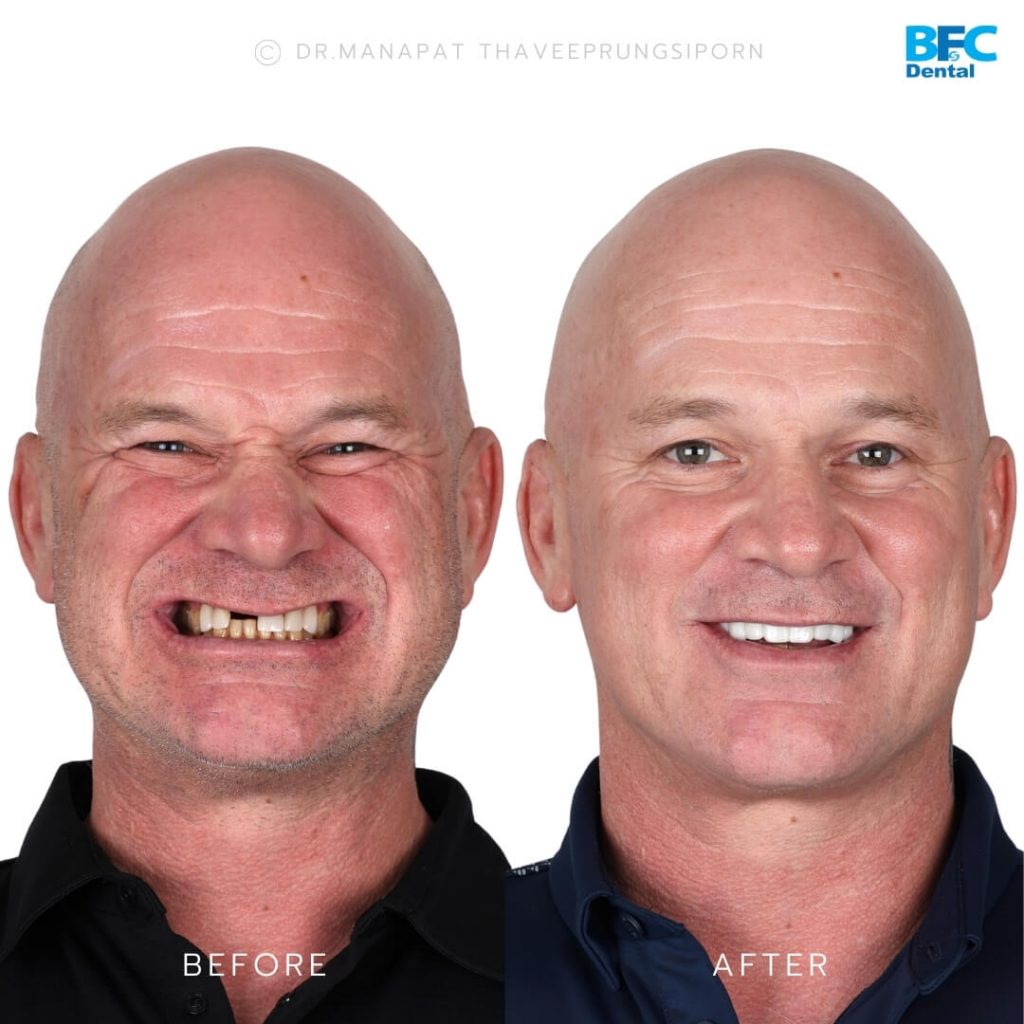 รากเทียมทั้งปาก All-on-4 สำหรับฟันบน