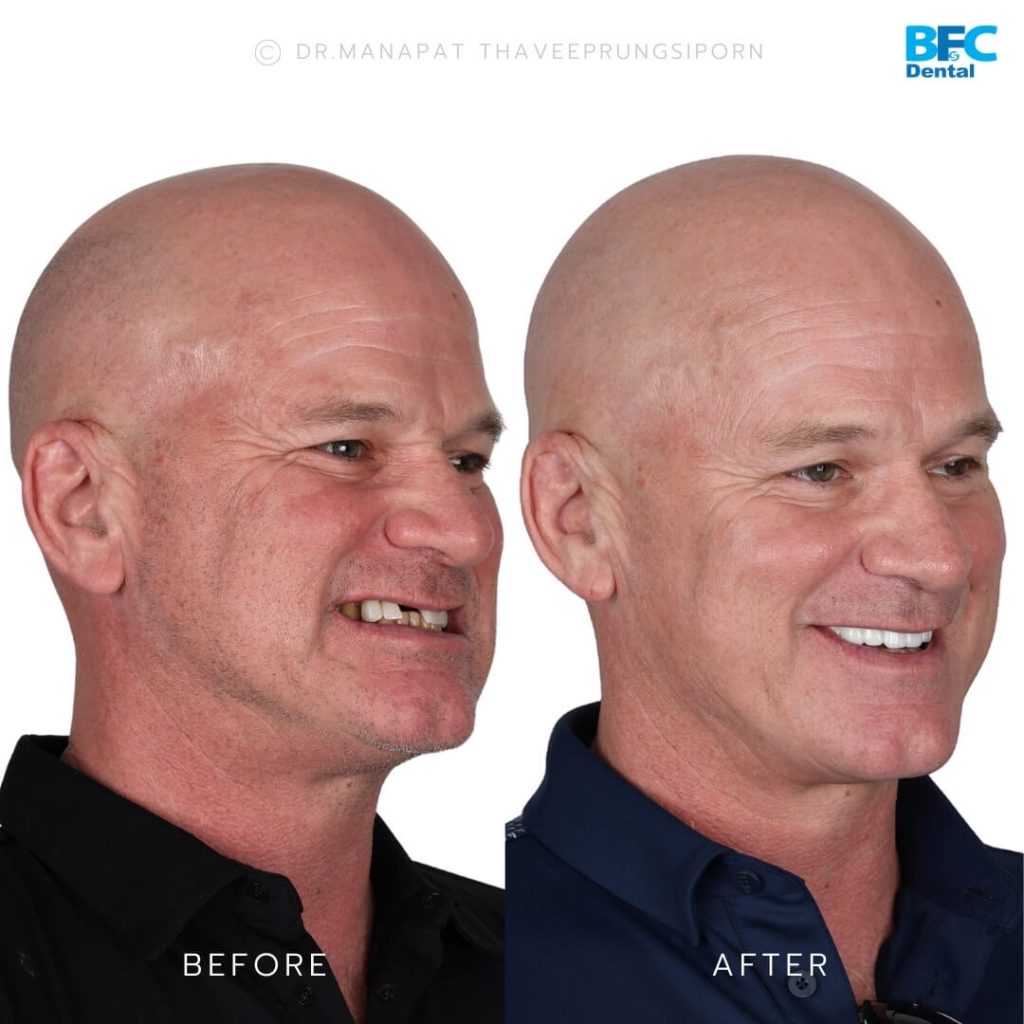 รากเทียมทั้งปาก All-on-4 สำหรับฟันบน