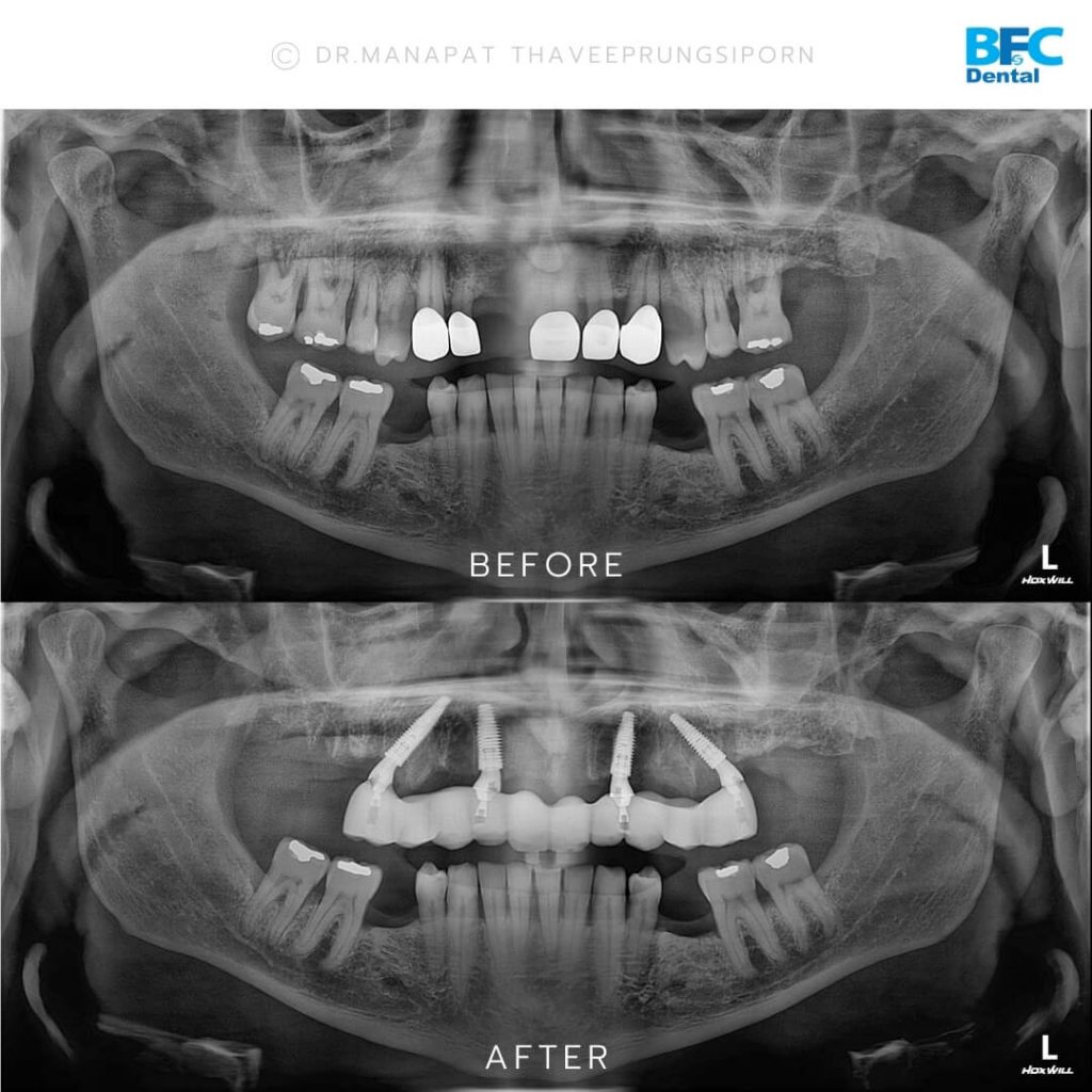 รากเทียมทั้งปาก All-on-4 สำหรับฟันบน