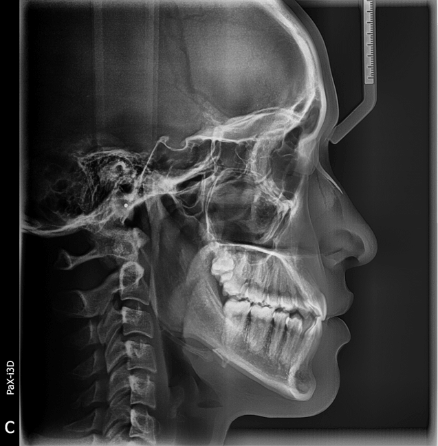 จัดฟันเร็ว Self-Ligating