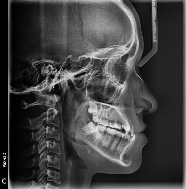 จัดฟันเร็ว Self-Ligating