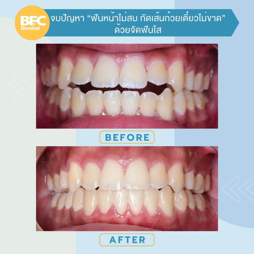 จัดฟันใส 