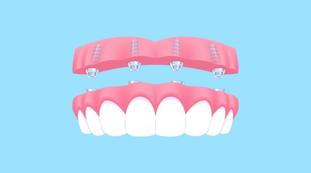 รากเทียมทั้งปากระบบ Full Digital Workflow 