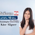 ฟันซ้อนเก แก้ได้ใน 10 เดือนไม่ใช่เรื่องบังเอิญด้วย จัดฟันใส Käse Aligner